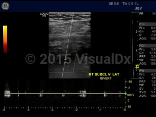 Imaging Studies image of Subclavian vein thrombosis - imageId=7873041. Click to open in gallery.  caption: 'Color Doppler image with spectral  analysis demonstrates absence of flow within the right subclavian vein,  consistent with thrombosis.'