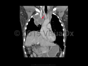 Imaging Studies image of Superior vena cava syndrome - imageId=7873123. Click to open in gallery.  caption: 'A 64 year old patient with known lung cancer presented with increasing facial swelling and shortness of  breath. Coronal CT image demonstrates encasement and obstruction of the SVC by a large right upper lobe mass. Findings consistent with SVC syndrome.'