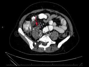 Imaging Studies image of Acute appendicitis - imageId=7873162. Click to open in gallery.  caption: 'Contrast enhanced axial image from CT scan demonstrating distended appendix with appendicolith.'