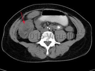 Imaging Studies image of Intussusception - imageId=7873692. Click to open in gallery.  caption: '<span>CT scan demonstrating colo-colo intussusception in the right lower quadrant.</span>'