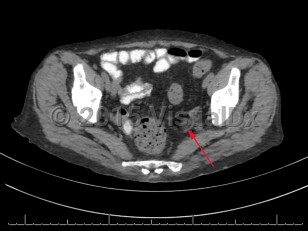 Imaging Studies image of Teratoma of ovary - imageId=7878204. Click to open in gallery.  caption: '<span>Axial CT demonstrating a fat-containing left adnexal lesion (arrow), consistent with a mature cystic teratoma.</span>'