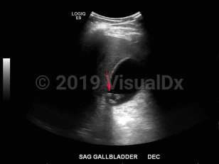 Imaging Studies image of Biliary calculus - imageId=7878647. Click to open in gallery.  caption: '<span>Ultrasound of the right upper  quadrant demonstrating echogenic foci with shadowing in the gallbladder  consistent with cholelithiasis.</span>'