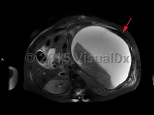 Imaging Studies image of Splenic infarction - imageId=7879111. Click to open in gallery.  caption: '<span>T2 MRI image of splenic infarct with large subcapsular hematoma.</span>'