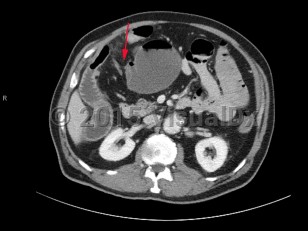 Imaging Studies image of Small bowel obstruction - imageId=7879387. Click to open in gallery.  caption: '<span>CT scan of the abdomen and  pelvis demonstrating a dilated cecum with "whirl sign," which is made up  of twisted bowel and mesocolon, consistent with cecal volvulus resulting in small bowel obstruction. </span>'