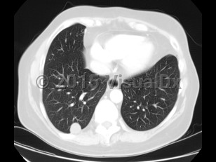 Imaging Studies image of Dirofilariasis - imageId=7879772. Click to open in gallery.  caption: '<span>CT image of pulmonary nodule</span>.'