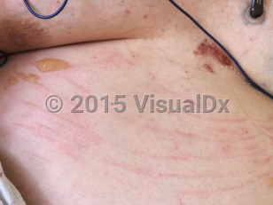 Clinical image of Acute edema blister - imageId=7880509. Click to open in gallery.  caption: 'Patterned vesicles, bullae, crusts, and surrounding erythema on an edematous abdomen.'