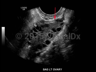 Imaging Studies image of Polycystic ovarian syndrome - imageId=7884589. Click to open in gallery.  caption: '<span>Transvaginal ultrasound demonstrates enlarged ovary with multiple, small peripheral follicles. </span>'