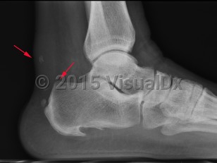 Imaging Studies image of Achilles tendonitis - imageId=7886591. Click to open in gallery.  caption: '<span>Achilles Tendonitis - rupture.  Lateral ankle radiograph demonstrates soft tissue thickening and  multiple, small dystrophic calcifications involving the distal Achilles  tendon compatible with chronic Achilles tendonitis. Note the presence of  a small bony bump along the posterosuperior calcaneus which may be the  early signs of a Haglund deformity.</span>'