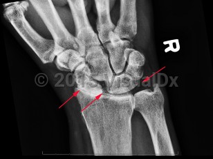 Imaging Studies image of Calcium pyrophosphate deposition disease - imageId=7889984. Click to open in gallery.  caption: '<span>CPPD of the wrist with  chondrocalcinosis of the TFCC and scapholunate ligaments. Note the  pronounced radiocarpal joint space narrowing at the radioscaphoid joint  with a stepladder appearance of the scaphoid to lunate transition which  is a finding compatible with CPPD arthropathy.</span>'
