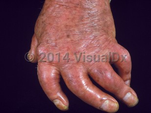Clinical image of Psoriatic arthritis - imageId=789580. Click to open in gallery.  caption: '<span>Arthritis mutilans.</span>'