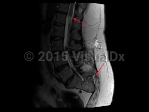 Imaging Studies image of Caudal regression syndrome - imageId=7900302. Click to open in gallery.  caption: '<span>Sag T2 MRI demonstrates an  abnormally developed sacral spine which is absent below the level of S2, and there is a cigar shaped/blunted appearance of the spinal cord which  terminates at T12. These findings are characteristic of caudal  regression syndrome.</span>'