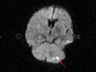 Imaging Studies image of Cerebellar stroke - imageId=7903644. Click to open in gallery.  caption: '<span>Diffusion weighted imaging  demonstrates increased signal in the left cerebellum. There was a  corresponding decrease in the ADC map, consistent with acute left  cerebellar infarction.</span>'