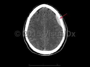 Imaging Studies image of Epidural intracranial hematoma - imageId=7904077. Click to open in gallery.  caption: '<span>Axial CT image demonstrates a  hyperattenuating extra-axial collection in the left frontal region. In  this post-traumatic patient, findings consistent with epidural hematoma.</span>'