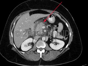 Imaging Studies image of Acute pancreatitis - imageId=7905756. Click to open in gallery.  caption: '<span>Axial image from contrast enhanced CT  scan demonstrates an enlarged pancreatic head with surrounding  inflammatory changes consistent with acute pancreatitis.</span>'