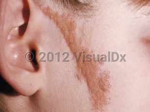 Clinical image of Nevus sebaceus - imageId=79068. Click to open in gallery.  caption: 'A light brown and yellowish cobblestone plaque with a linear configuration on the lateral cheek.'