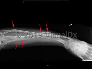 Imaging Studies image of Familial hypophosphatemic rickets - imageId=7907912. Click to open in gallery.  caption: '<span>Severe osteopenia (with a  blurry lucent/sclerotic appearance), with multiple looser zones involving  the tibia, resulting in lateral bowing and a healing fracture of the  proximal fibula. Findings are compatible with the clinical history of  hypophosphatemic rickets.</span>'