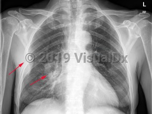 Imaging Studies image of Lung cancer - imageId=7909788. Click to open in gallery.  caption: '<span>There is a large mass within the right lung in a perihilar location compatible with bronchogenic carcinoma. There is metastatic disease involving the right 5th rib with bony destruction, and a large extrapleural mass.</span>'