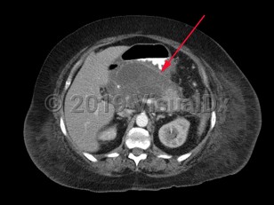 Imaging Studies image of Pancreatic pseudocyst - imageId=7911900. Click to open in gallery.  caption: 'CT scan of the abdomen demonstrates a well-defined pancreatic fluid collection consistent with a pancreatic pseudocyst.'