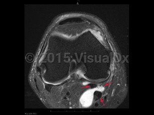 Imaging Studies image of Popliteal cyst - imageId=7921070. Click to open in gallery.  caption: '<span>Axial intermediate fat  saturated MRI sequence demonstrates a popliteal cyst (Baker's cyst), with  fluid tracking between the medial head of the gastrocnemius and  semimembranosus tendons.</span>'