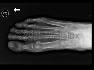 Imaging Studies image of Osteoporosis - imageId=7923513. Click to open in gallery.  caption: '<span>Diffuse osteopenia of the foot  with marked demineralization and decreased cortical thickness of all the bones. These are radiographic findings, which can be seen in the  setting of osteoporosis.</span>'