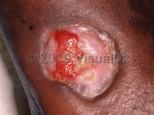 Clinical image of Pyoderma gangrenosum - imageId=798076. Click to open in gallery.  caption: 'A close-up of a large ulcer with surrounding re-epithelialization.'