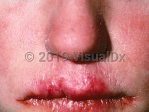 Clinical image of Chronic mucocutaneous candidiasis - imageId=800510. Click to open in gallery.  caption: 'Fissuring, erosion, and erythema of the lips.'