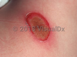 Clinical image of Bullous impetigo - imageId=813507. Click to open in gallery.  caption: 'A close-up of a crusted erosion with a collarette of scale.'