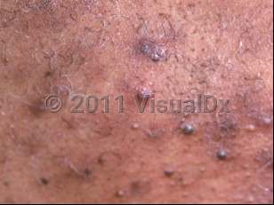Clinical image of Steroid acne - imageId=816855. Click to open in gallery.  caption: 'A close-up of follicular-based closed comedones and papules.'