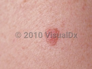 Clinical image of Lichenoid keratosis - imageId=82272. Click to open in gallery.  caption: 'A close-up of a pink-brown, edematous, stuck-on, verrucous plaque.'