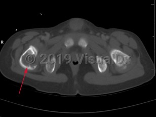 Imaging Studies image of Eosinophilic granuloma - imageId=8322100. Click to open in gallery.  caption: '<span>Axial CT of the pelvis  demonstrates a large lytic lesion involving the right hip with cortical  destruction. This pediatric patient also had multiple other sites of  lytic lesions, including the skull. Given the constellation of findings,  this is most compatible with an eosinophilic granuloma.</span>'