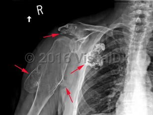 Imaging Studies image of Multiple hereditary exostoses - imageId=8336227. Click to open in gallery.  caption: 'I<span>n a patient with multiple  hereditary exostoses, there are multiple sessile and pedunculated  osteochondromas projecting off of the humerus, scapula, and clavicle.</span>'