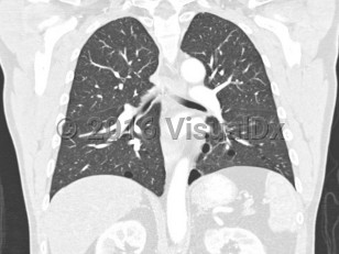 Imaging Studies image of Birt-Hogg-Dubé syndrome - imageId=8346944. Click to open in gallery.  caption: '<span>Coronal 2 mm slice thickness  CT image viewed in lung windows. Multiple lung cysts with a basilar  predominance, with the largest cyst located 	in the lower lobes. Many of the  cysts are in a subpleural position. Note thin cyst walls (<1), and lack  of internal structure within the cysts.</span>'