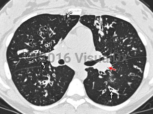 Imaging Studies image of Cystic fibrosis - imageId=8355125. Click to open in gallery.  caption: '<span>Non-contrast CT image of the chest viewed in lung windows in the middle lungs. There is bilateral upper and mid lung zone cylindrical bronchiectasis with relative sparing of the basal segments (straight black arrows). Multiple regions of mucous plugging are evident and associated with airway wall thickening (straight white arrow). Consolidation within the middle lobe and lingual are the result of atelectasis, secondary to mucous plugging. Tree-in-bud opacities throughout reflect small airways dilation and inspissation of mucous (curved white arrows). Bilateral hilar adenopathy is present (red straight arrow).</span>'