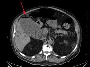 Imaging Studies image of Emphysematous cholecystitis - imageId=8355357. Click to open in gallery.  caption: '<span>Image from CT scan demonstrates a distended gallbladder with air in the wall. The patient also had gallstones. </span>'