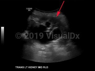Imaging Studies image of Hydronephrosis - imageId=8359154. Click to open in gallery.  caption: '<span>Transverse grayscale ultrasound image of the left kidney demonstrates moderate to severe hydronephrosis.</span>'