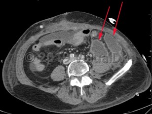 Imaging Studies image of Intraabdominal abscess - imageId=8359567. Click to open in gallery.  caption: '<span>Axial image from contrast enhanced CT scan of the abdomen with multiple rim enhancing fluid collections, consistent with abscess.</span>'