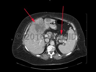 Imaging Studies image of Metastatic pancreatic carcinoma - imageId=8360130. Click to open in gallery.  caption: '<span>Axial image from enhanced CT scan of the abdomen showing a low attenuation mass at the pancreatic tail, (long arrow), consistent with pancreatic cancer with associated multiple low attenuation liver lesions, consistent with metastases, (short arrow).</span>'