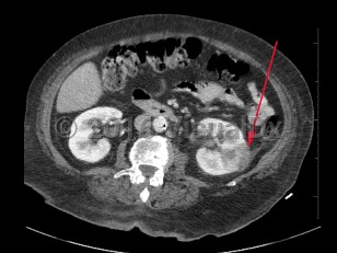 Imaging Studies image of Pyelonephritis - imageId=8360960. Click to open in gallery.  caption: '<span>Axial image from contrast enhanced CT scan demonstrating a peripheral, wedge-shaped, low attenuation region in the left kidney, consistent with pyelonephritis with possible abscess.</span>'