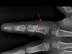 Imaging Studies image of Periosteal chondroma - imageId=8364755. Click to open in gallery.  caption: '<span>Radiograph of the ring finger demonstrates a lytic lesion involving the ulnar aspect of the proximal phalanx with saucerization of the cortex, a deep sclerotic margin, and chondroid calcifications extending into the soft tissues. These imaging findings at this location are most suggestive of a juxticortical chondroma.</span>'