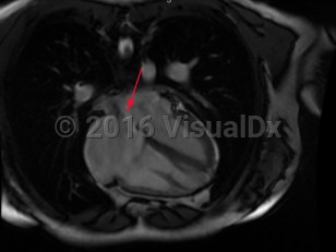 Imaging Studies image of Atrial septal defect - imageId=8368132. Click to open in gallery.  caption: '<span>Cardiac MRI without contrast demonstrates opening in atrial septum, consistent with atrial septal defect.</span>'