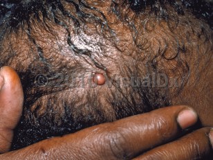 Clinical image of Juvenile xanthogranuloma - imageId=83903. Click to open in gallery.  caption: 'A dome-shaped, orange-red papule on the scalp.'