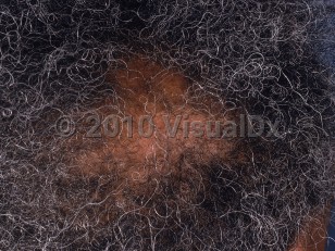 Clinical image of Central centrifugal cicatricial alopecia - imageId=848531. Click to open in gallery.  caption: 'A patch of scarring alopecia on the parietal scalp.'