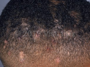 Clinical image of Tinea capitis - imageId=853703. Click to open in gallery.  caption: 'Small patches of scarring and non-scarring alopecia and some associated scaling on the scalp.'