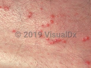 Clinical image of Fire ant sting - imageId=859747. Click to open in gallery.  caption: 'A close-up of numerous erythematous papules, some in a curvilinear array.'