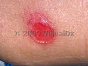 Clinical image of Stage 2 pressure injury - imageId=86407. Click to open in gallery.  caption: 'A close-up of a shallow ulcer with an adjacent small, scaly, pink plaque.'