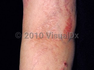 Clinical image of Steroid atrophy - imageId=87413. Click to open in gallery.  caption: 'A shiny, atrophic plaque in the antecubital fossa and surrounding white and brightly erythematous, curvilinear plaques (striae).'