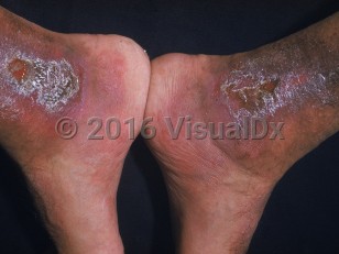 Clinical image of Alpha thalassemia - imageId=876349. Click to open in gallery.  caption: 'Ulcerated scaly plaques with surrounding erythema at the ankles.'
