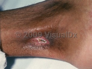Clinical image of Sickle cell disease - imageId=878592. Click to open in gallery.  caption: 'A healed ulcer showing a superficial crust and surrounding deep pink scarring at the ankle.'