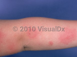 Clinical image of Solar urticaria - imageId=879551. Click to open in gallery. 
