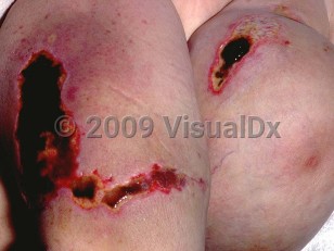 Clinical image of Heparin necrosis - imageId=88284. Click to open in gallery.  caption: 'Angulated ulcers with overlying thick eschars and surrounding yellow slough on the thighs.'
